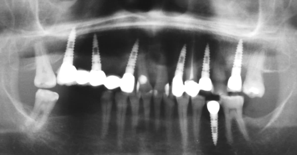 Rimozione di un impianto dentale per prevenire possibili patologie sinusali